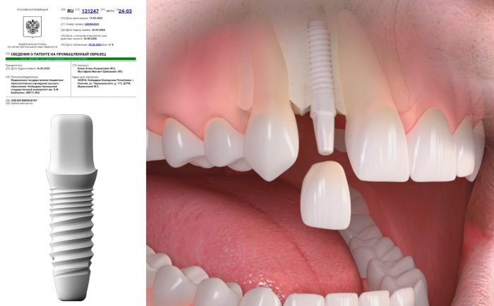 patent-na-zubnoj-implant-kbgu-700x434